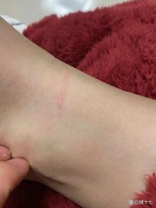 狗牙蹭了一下有个红点_狗咬伤留红点？别大意，速洗观察，需警惕